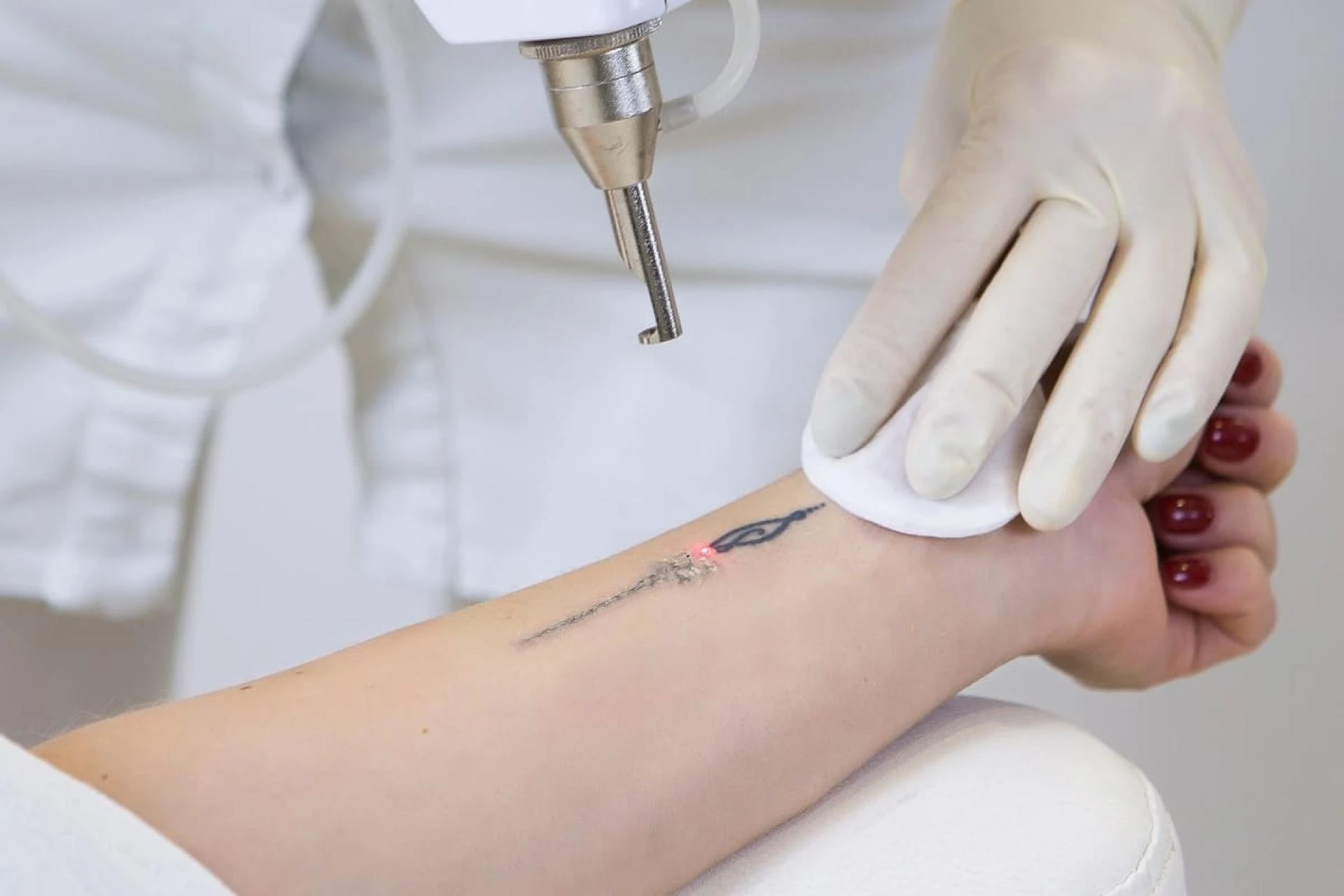 Laser Tattoo Removal for Colored Tattoos: Which Machine Works Best?