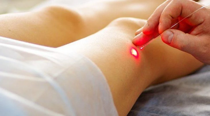 The Next Big Thing in Varicose Vein Treatment Devices Market
