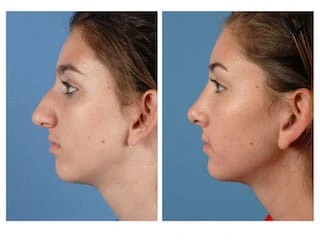 Rhinoplasty