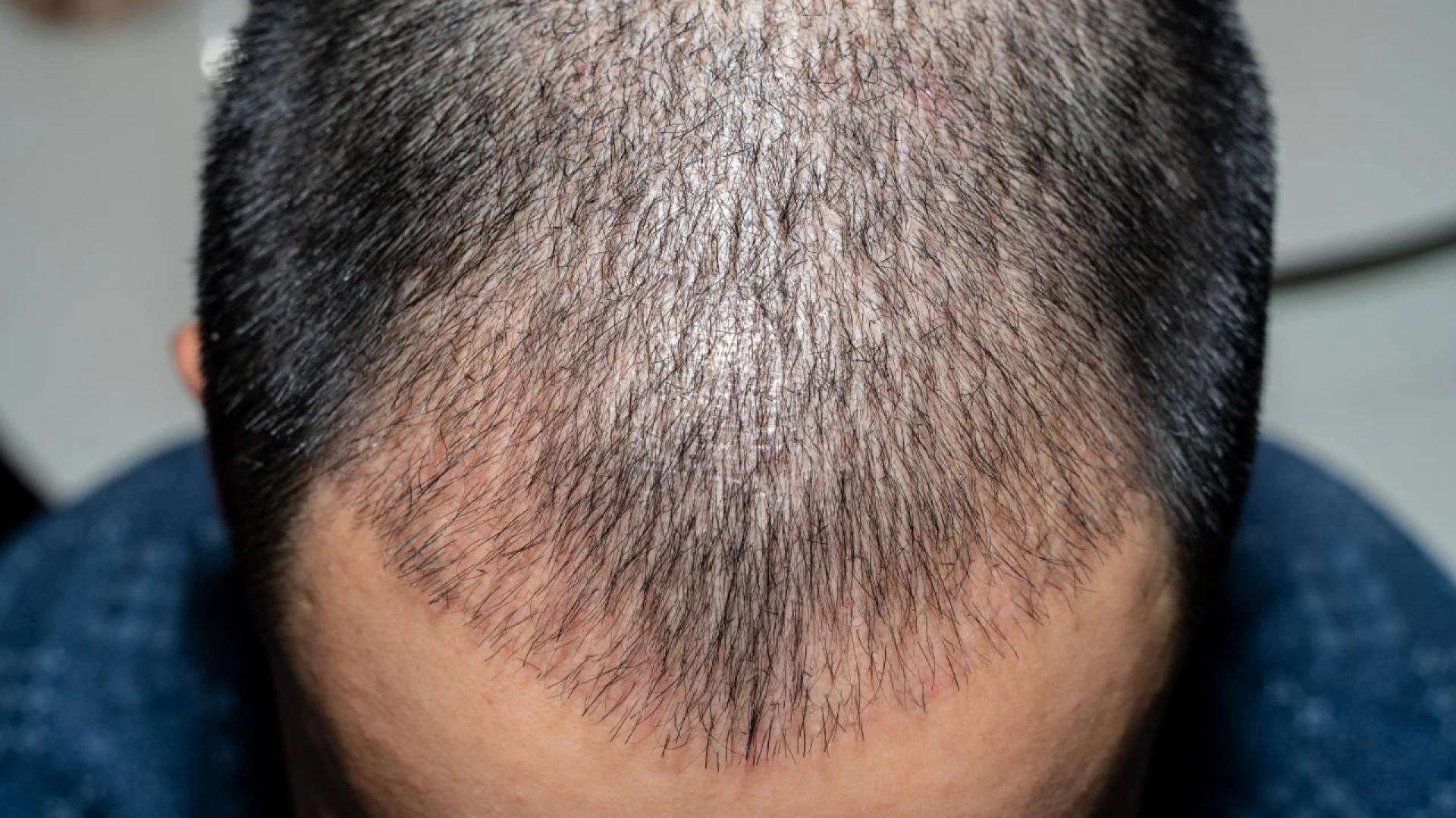 what is Important to Know Before a Hair Transplant