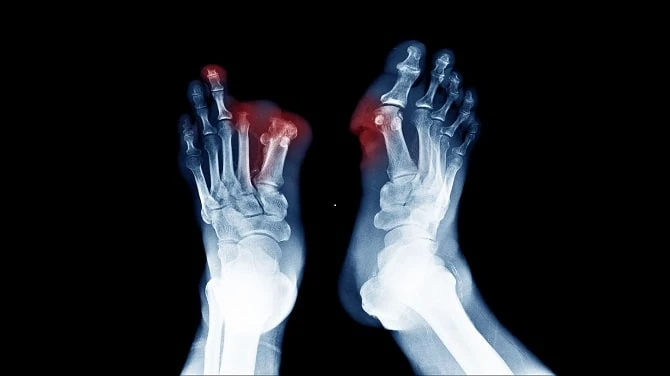CAN STEM CELLS BE USED TO TREAT NEUROPATHY IN DIABETICS?