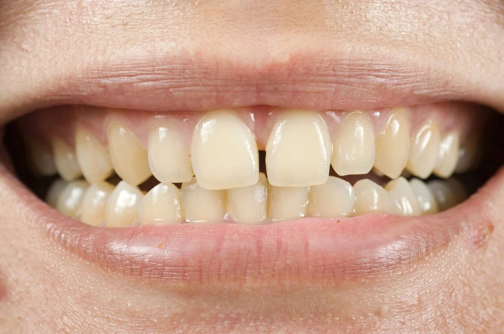 What Causes Yellow and Stained Teeth in Teens and Adults?
