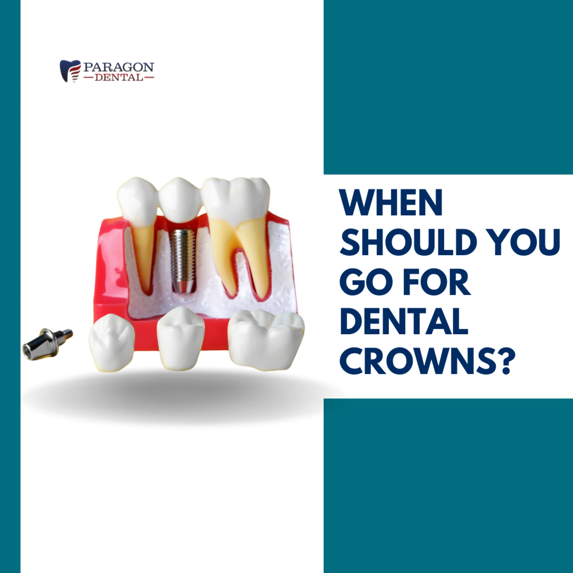 When Should You Go For Dental Crowns?
