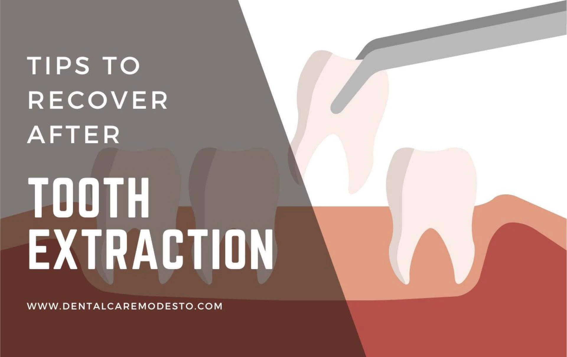 Dos and Don’ts After Tooth Removal