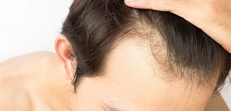 What Are The Elements That Decide Hair Transplant Cost in India?