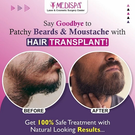Everything To Know About Beard Hair Transplant