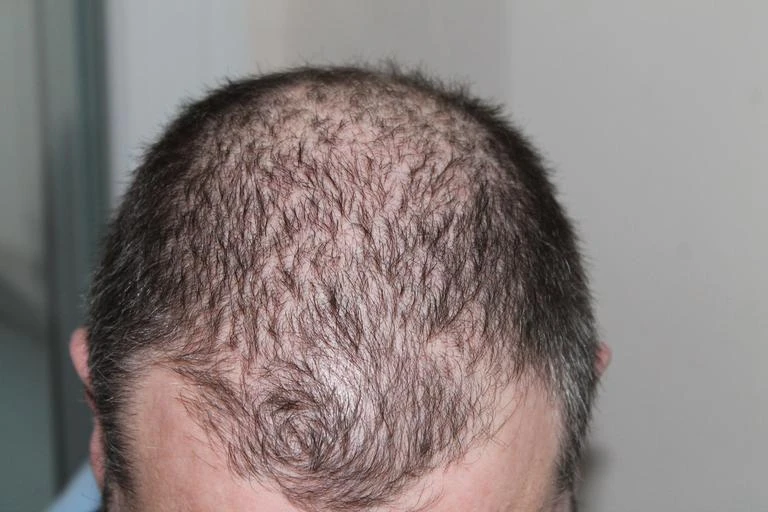 Describe The Factors That Affect Hair Transplant Cost in Udaipur