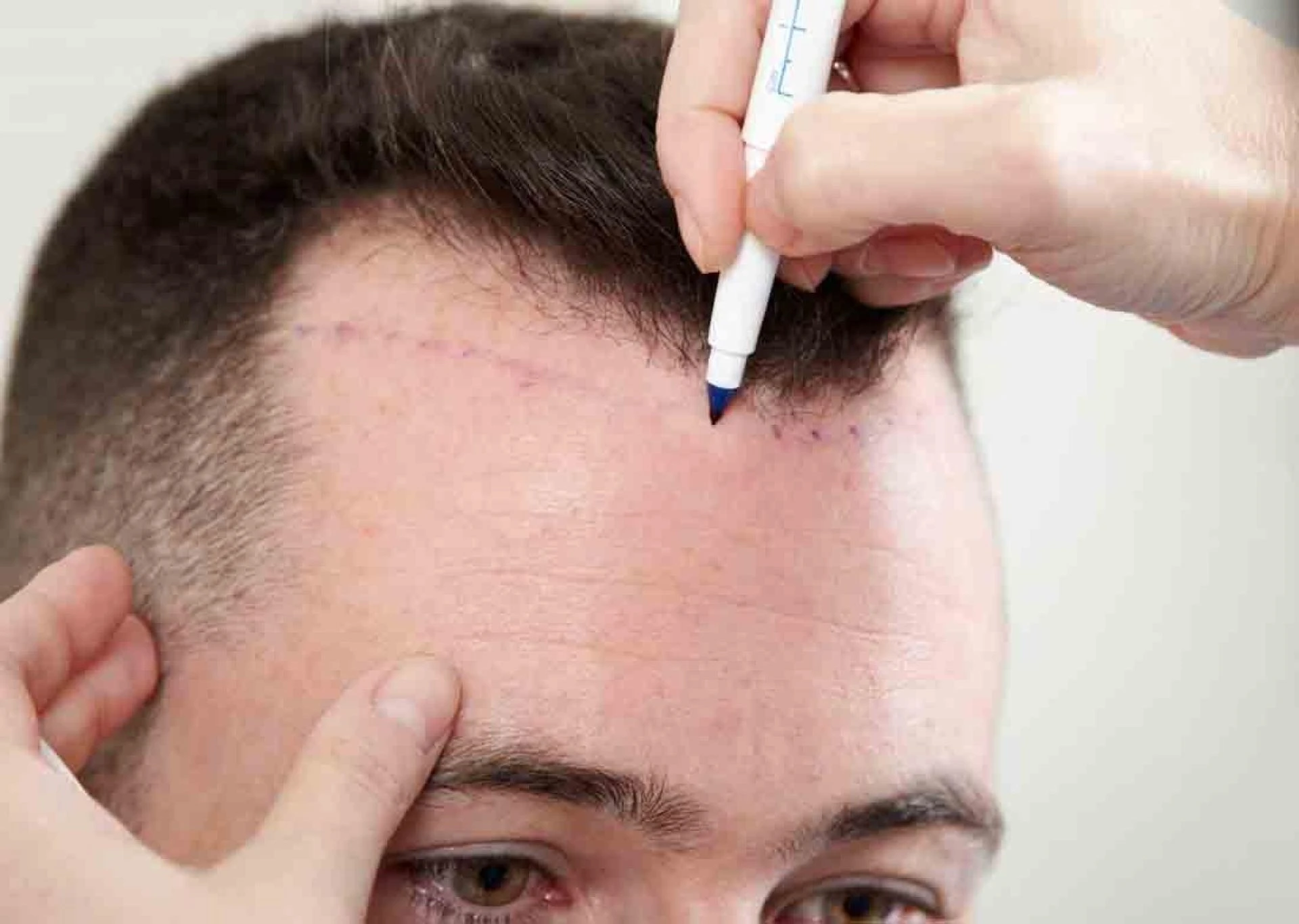 How To Get Safe And Effective Hair Transplant Surgery?