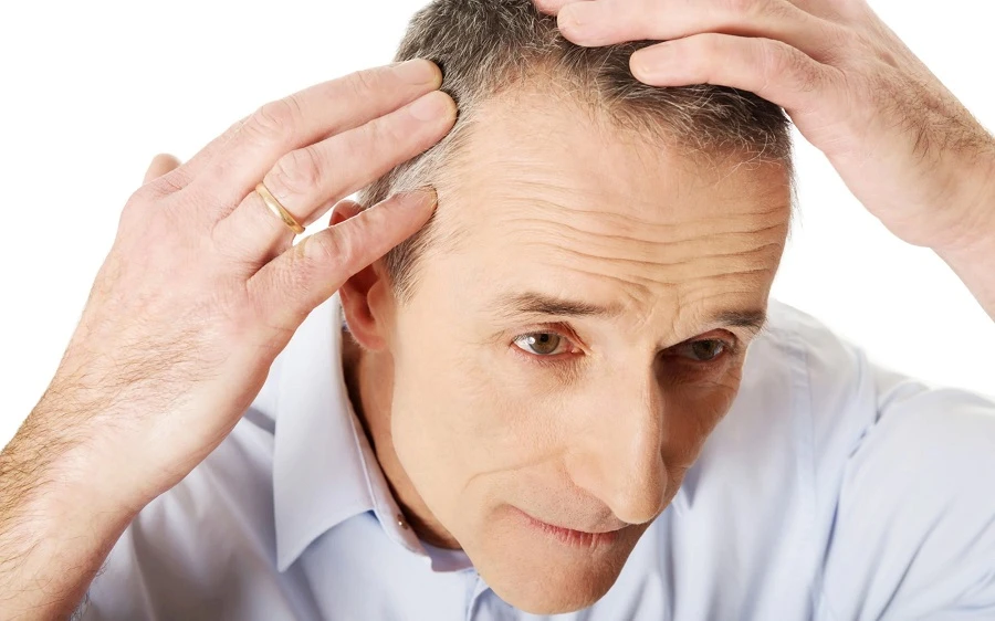 What is The Ideal Time to Undergo Hair Transplant Procedure?