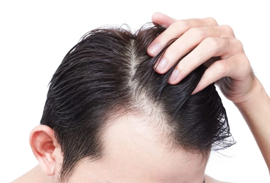 Criteria To Choose The Best Clinic For Hair Transplant in Noida