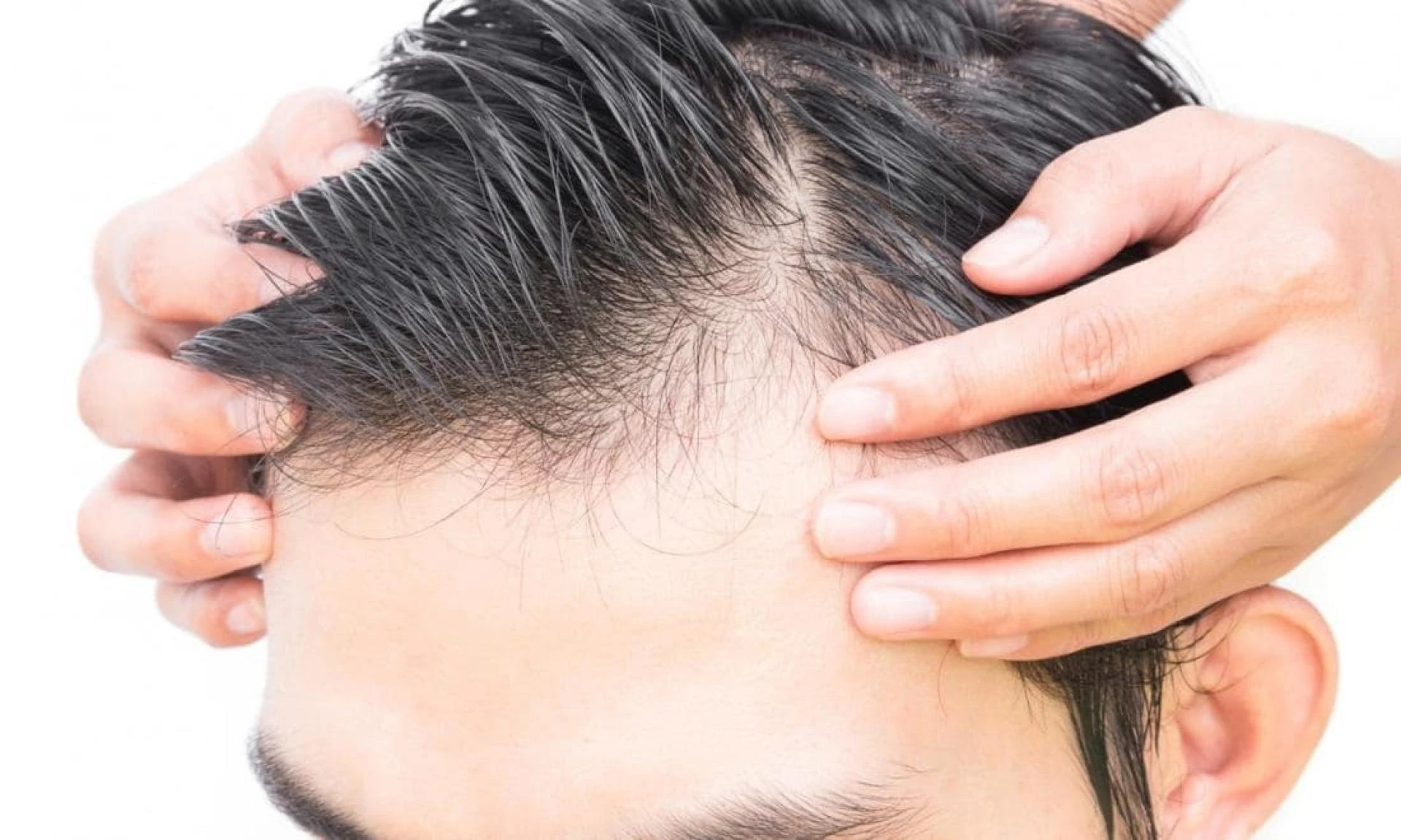 What Are The Common Myths And Facts About Hair Transplant?