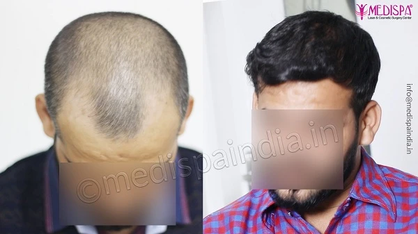 How To Find The Best Doctor For Hair Transplant in Bangalore?