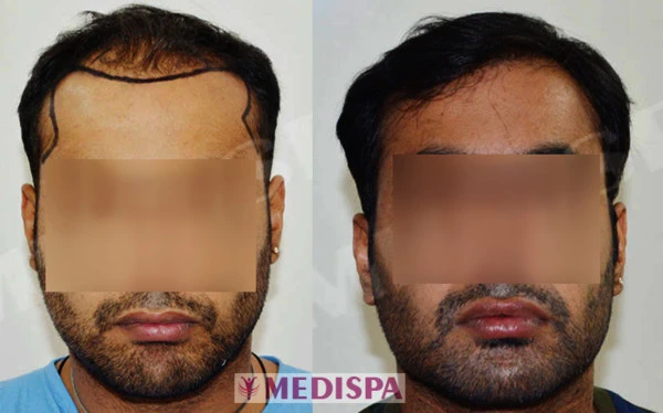 How To Find The Best Hair Transplant Clinic In Indore?
