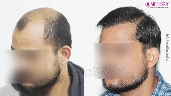 How To Find The Best Hair Transplant Clinic in Pune?