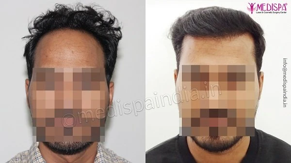 How to get the best hair transplant in Delhi NCR