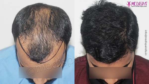 What Is The Importance Of Primary Consultation Before Hair Transplant?