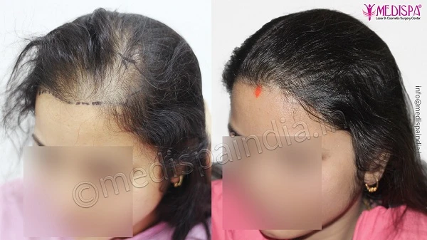 How To Get Natural And Fair Density From Female Hair Transplant?