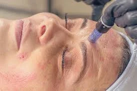 Unveiling the Power of Microneedling with Dermapen Treatment