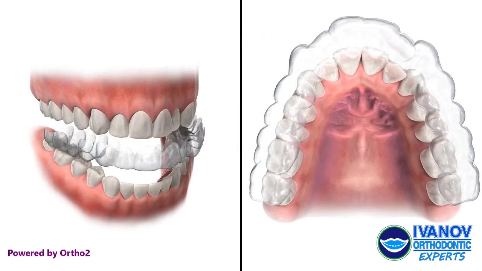 How To Get The Best Nearest Invisalign Treatment At Affordable Rates?