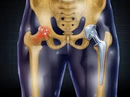Why Choose Phoenix for Your Total Hip Replacement Recovery: