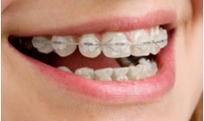 Clear Braces in Evansville: A Comprehensive Guide to a Beautiful Smile
