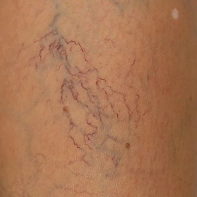 Red Light Therapy: An Affordable Option for Spider Vein Treatment