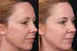 Brighter Horizons: Navigating Melasma Treatment for Dark Spot Clearance