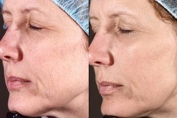 10 Tips for Making the Most of Carbon Peel