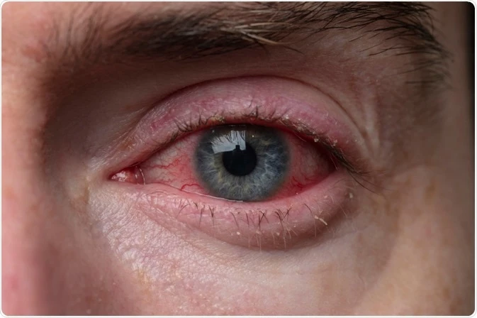 Blepharitis Treatment Market | Trends,Size, Growth, Share, COVID-19 Impact ...