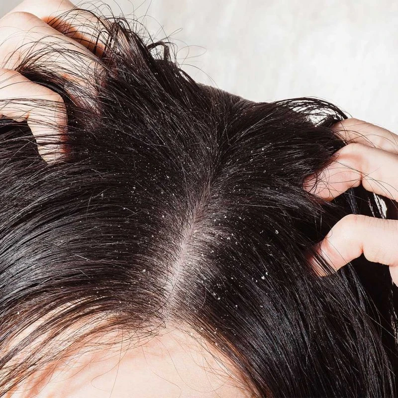 Scalp Hygiene 101: Tips for Keeping Greasy Dandruff at Bay