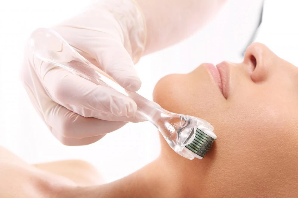 Microneedling for Acne Scars
