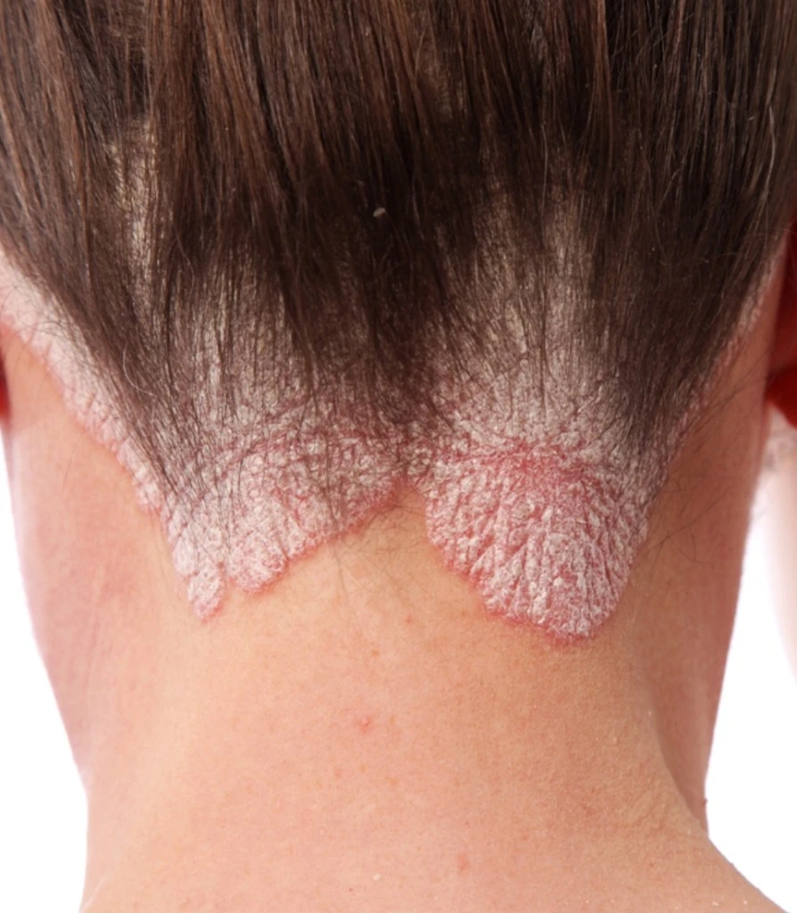 Three Essential Skin Care Tips for Psoriasis