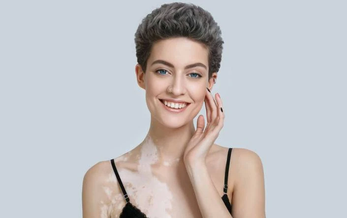 Vitiligo Treatment In Ludhiana