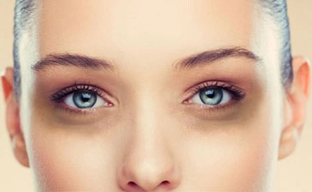 Identifying the Causes and Treatment Options for Dark Circles