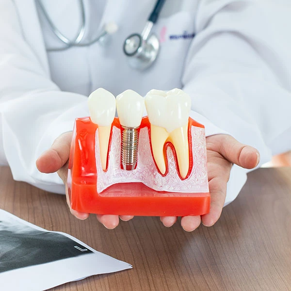 What is dental implant surgery?