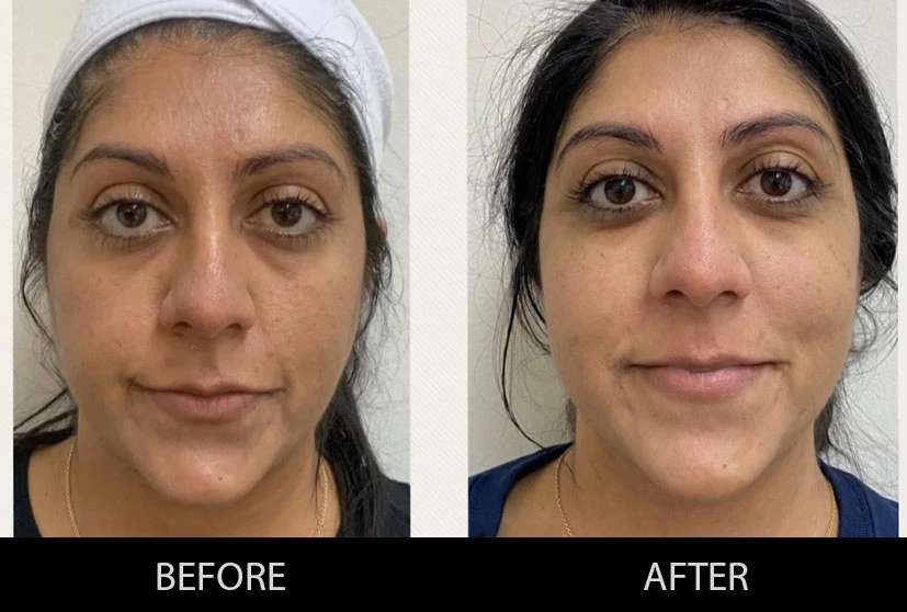 How does skin-laser treatment work?