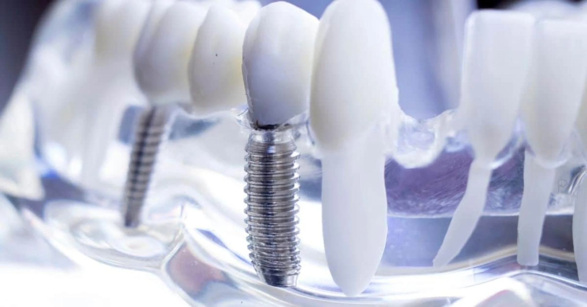 What are some dental implant centers in India?
