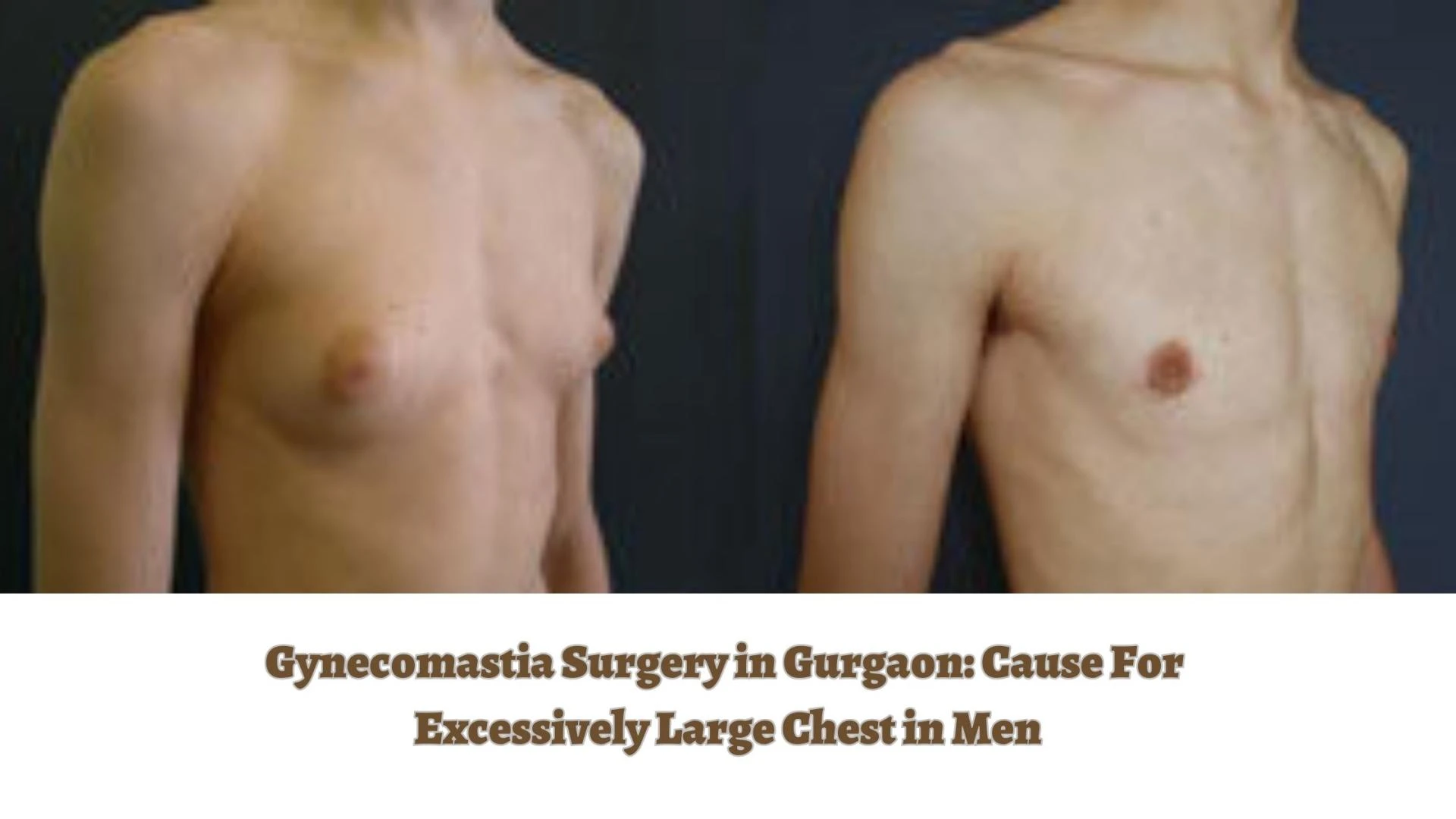 Gynecomastia Surgery: Cause For Excessively Large Chest in Men