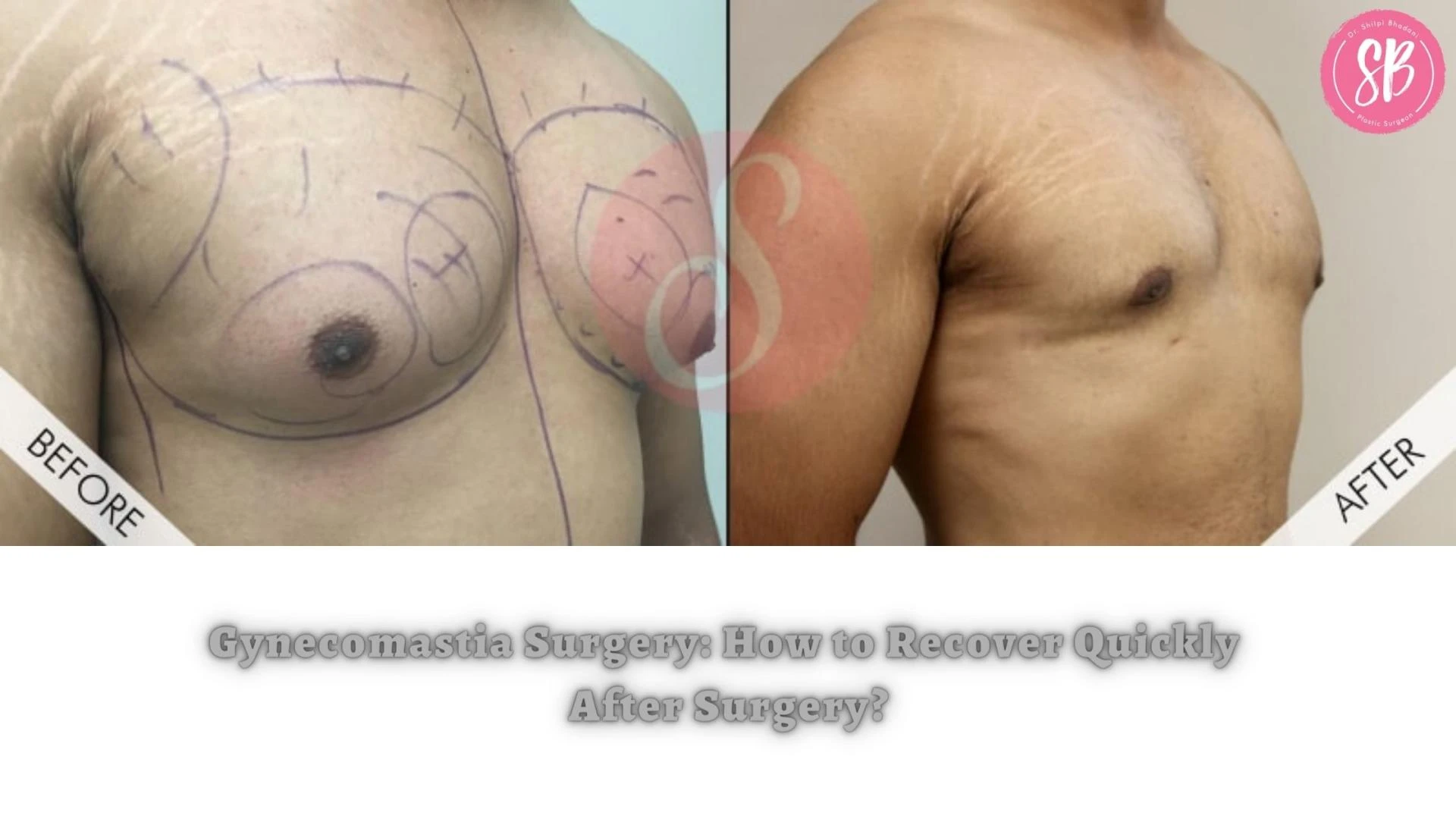 Gynecomastia Surgery: How to Recover Quickly After Surgery?