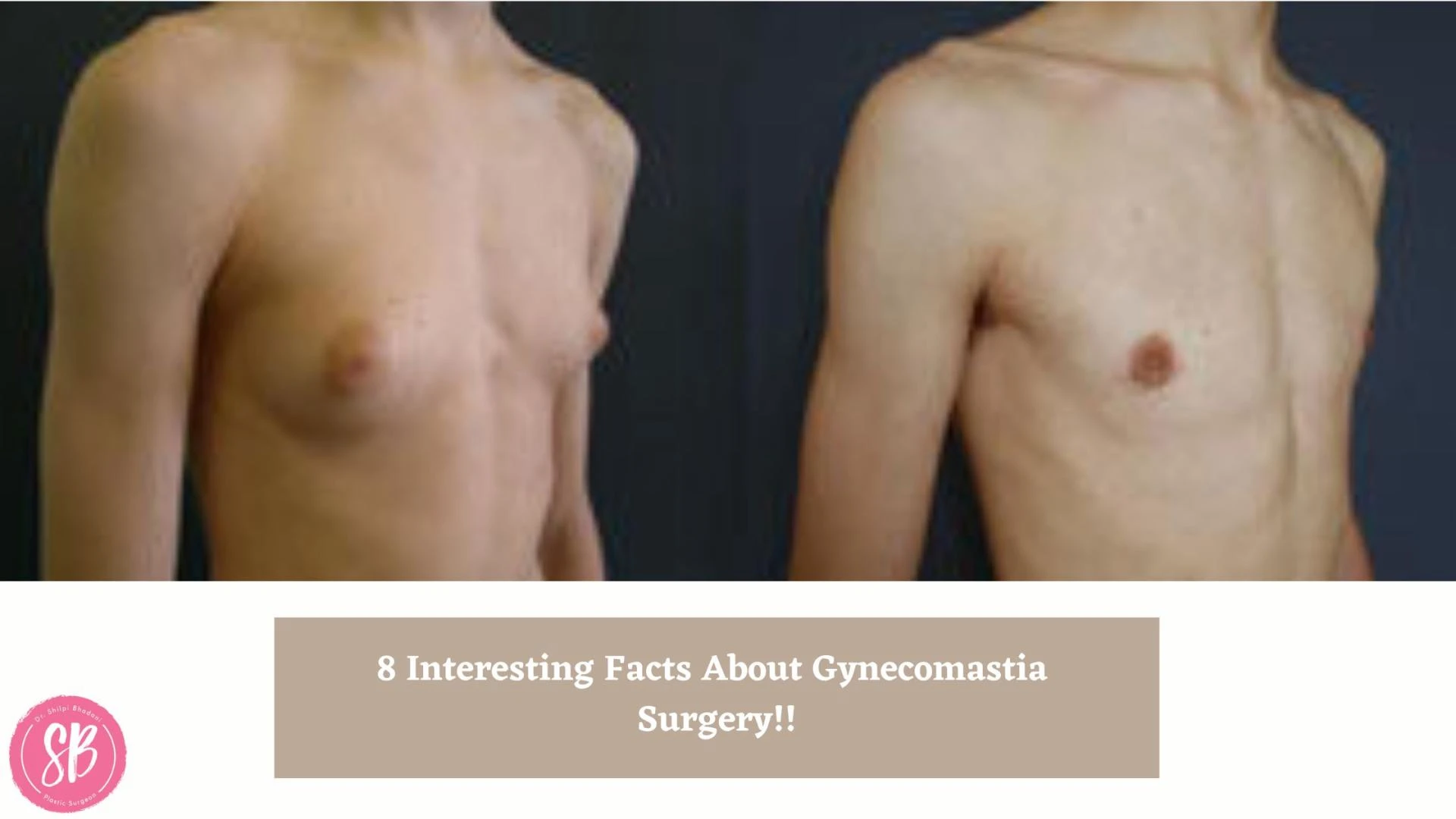 8 Interesting Facts About Gynecomastia Surgery