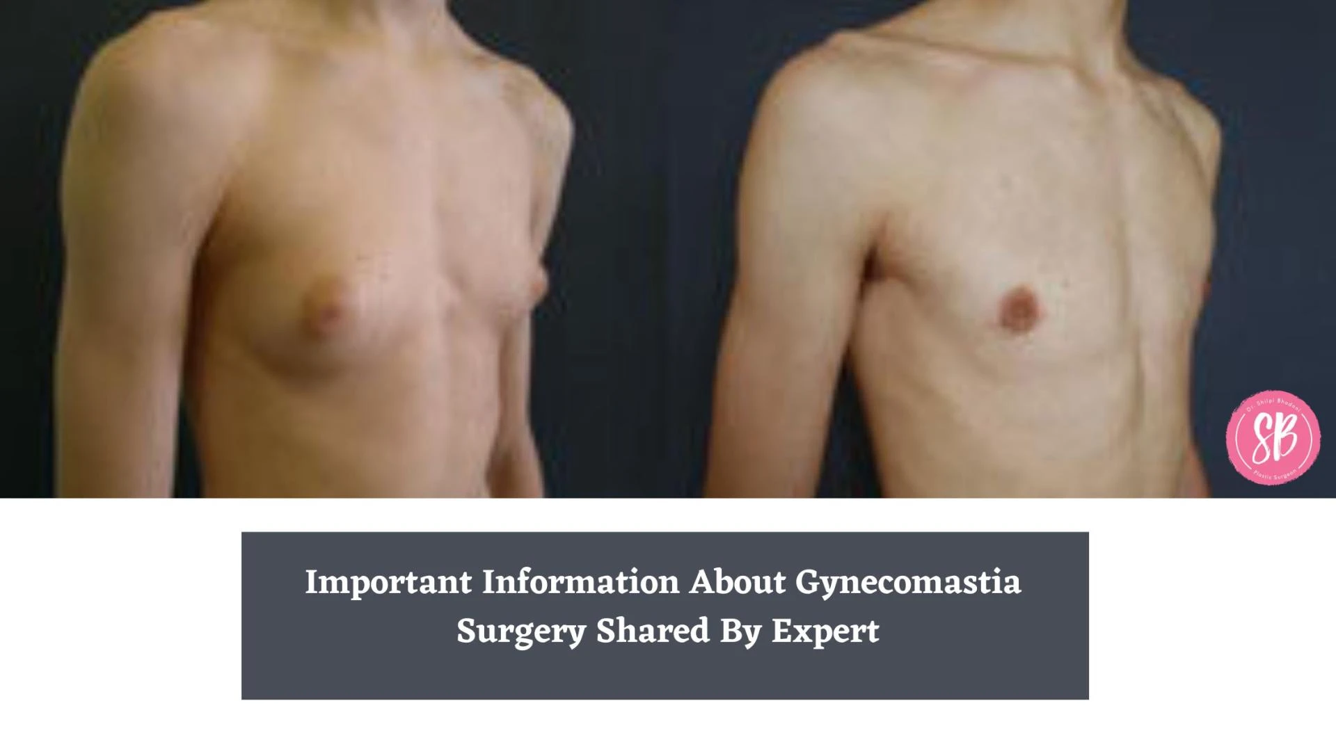 Important Information About Gynecomastia Surgery Shared By Expert