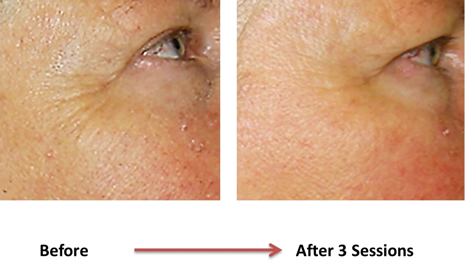 Timeless Beauty: Exploring Wrinkle Treatment in Victoria, BC