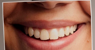 Carthage Invisalign