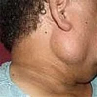 4 Essеntial Tips Bеforе Parotidеctomy - a Bеginnеr's Guidе