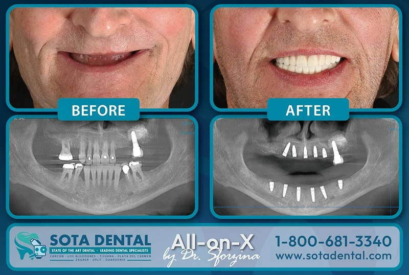 full mouth dental implants mexico