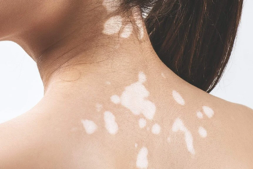 Vitiligo Specialist in Delhi