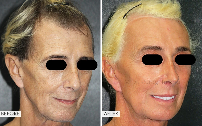 Facial Feminization Surgery: Before and After Results