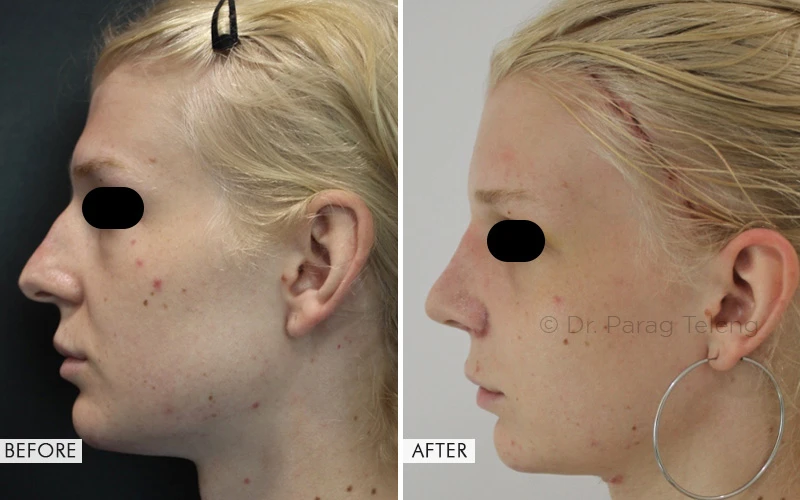 View Facial Feminization Surgery Before and After Results
