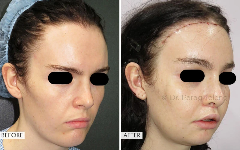 Facial Feminization Surgery Cost in USA, UK and India
