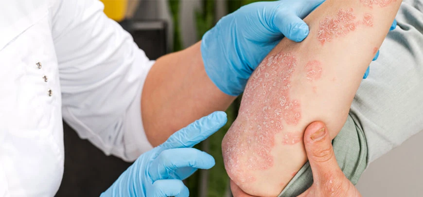 Psoriasis Best Treatment In Chennai